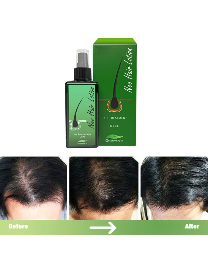 neo hair lotion I 100 % effective neo hair lotion for hair growing oil.World  best solution