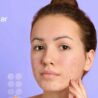 RemeCure-Scar-Acne@4x-100.jpg
