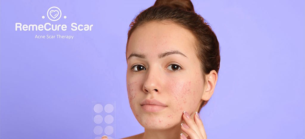 RemeCure-Scar-Acne@4x-100.jpg